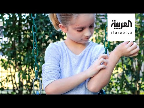 كيف نتعامل مع إكزيما الأطفال